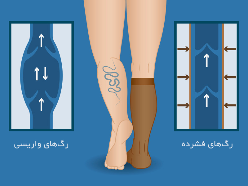 عملکرد-جوراب-واریس