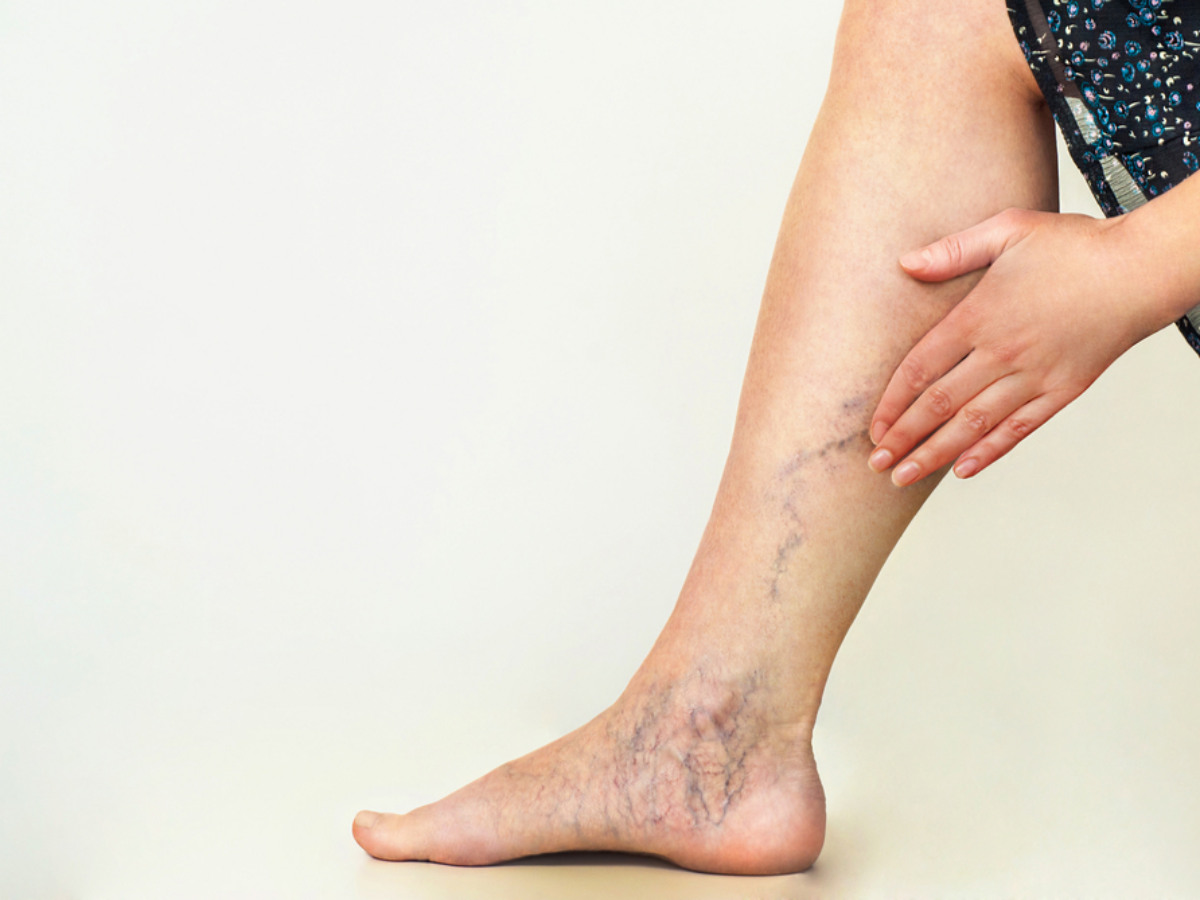 Varicose_Veins_Treatment_What_Should_You_Expect_638163075156556263-1200x900 Varicose_Veins_Treatment_What_Should_You_Expect_638163075156556263-1200x900