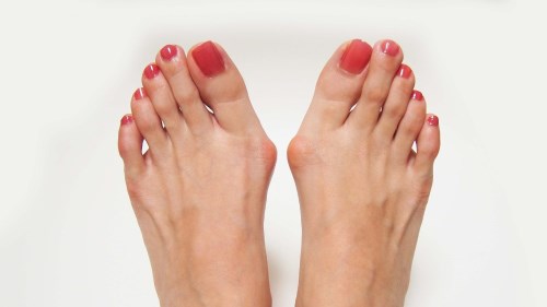 hallux-valgus-course
