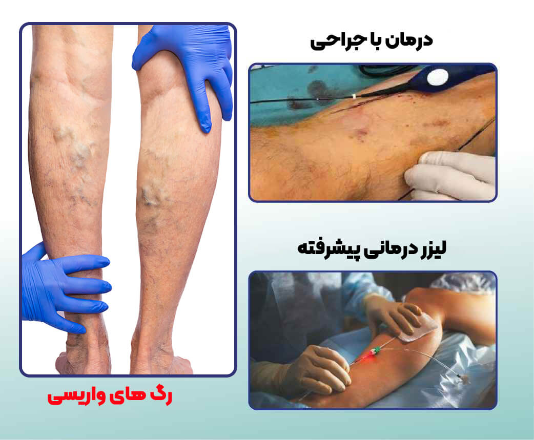 واریس-پا